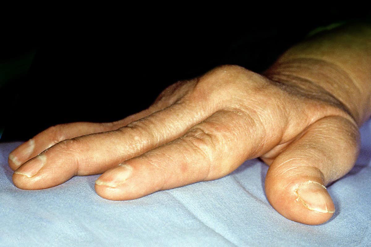 rheumatoid arthritis