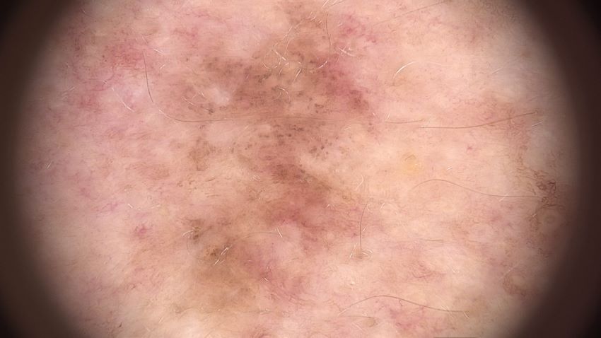 A photograph of a light brown spot on skin