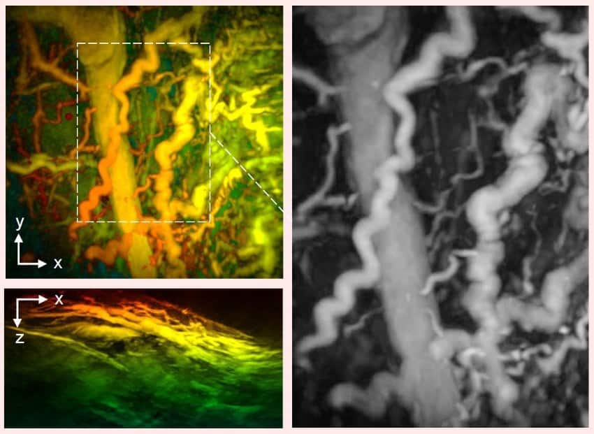 A composite image of 3 scans. The 2 on the left are in yellow, greens, and oranges, and the right image is in black and white. They show 3d images of blood vessels.