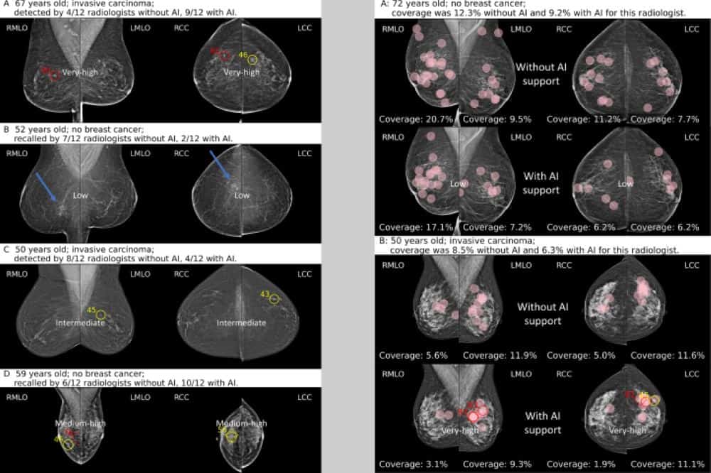 Two sets of screening mammograms