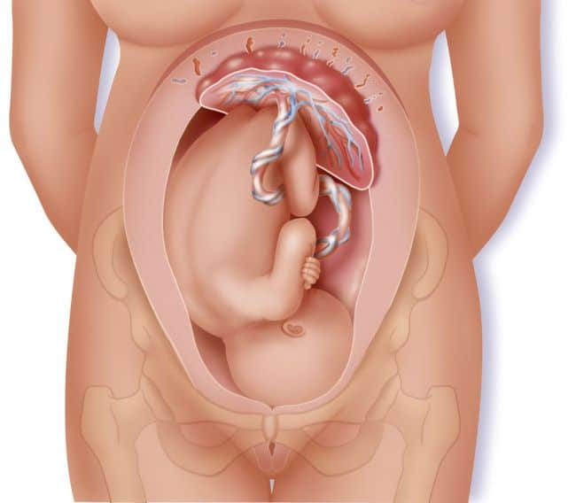 Illustration of fetus, umbilical cord and placenta.