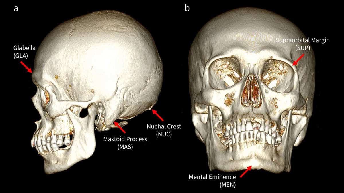 Ct scan of skull facing forward and to side with annotations on black background