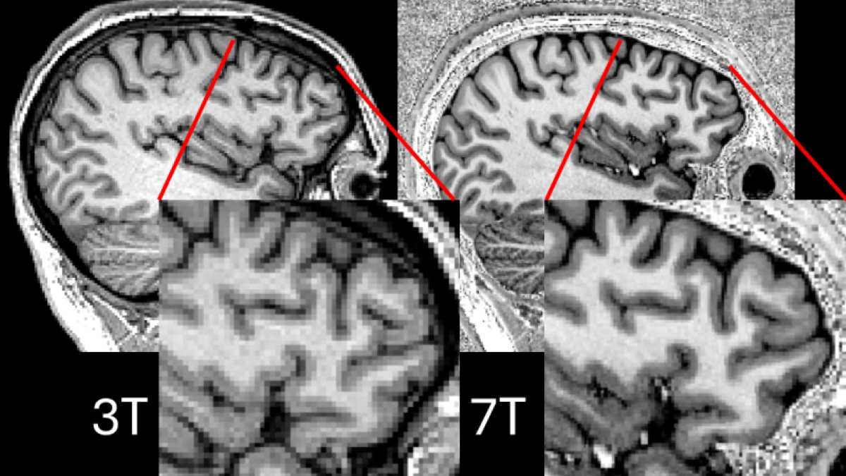 Comparison of images produced using existing 3T MRI imaging (left) and parallel transmit 7T MRI (right). Both images show a side view of the brain with close ups shown in the inset frames. (Supplied Cambridge Uni)