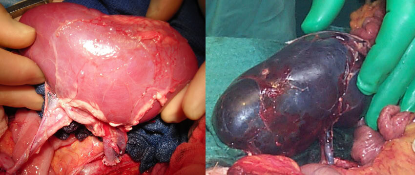 2 images of kidneys during transplant surgery. The left is pink and healthy looking, the right is dark purple and swollen