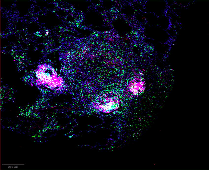 Microscope image of tuberculosis infection showing cells in pink, blue, and green