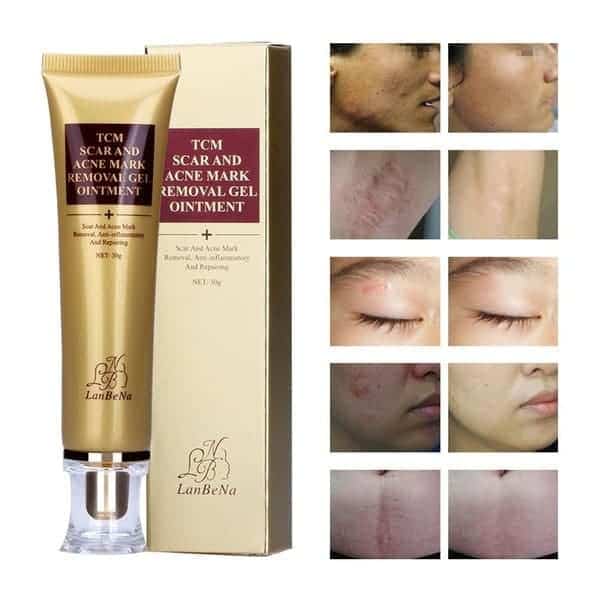 משחה לצלקות