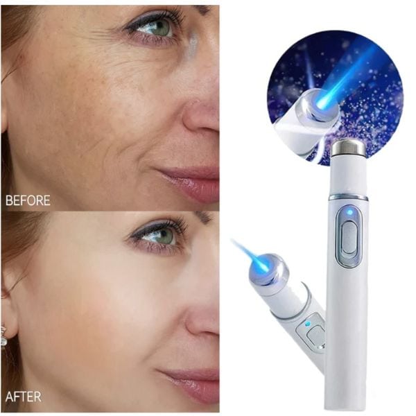 עט לייזר טכנולוגיית X RAY להסרת כתמים וקמטים בפנים