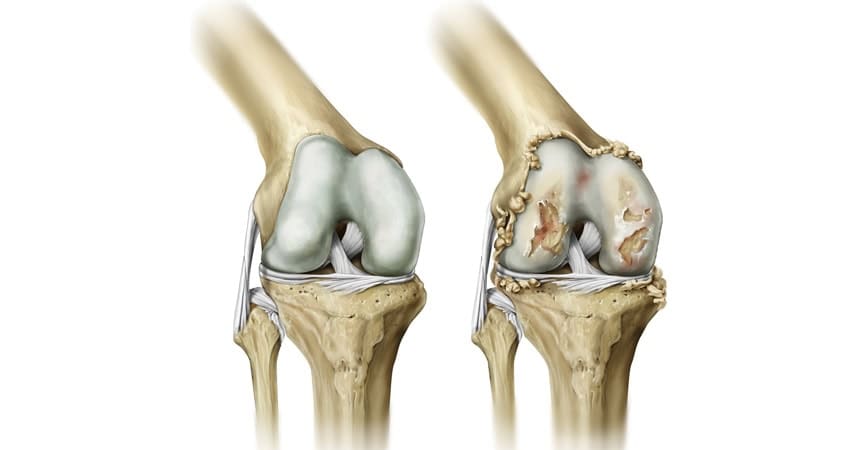 osteoartrit-nedir