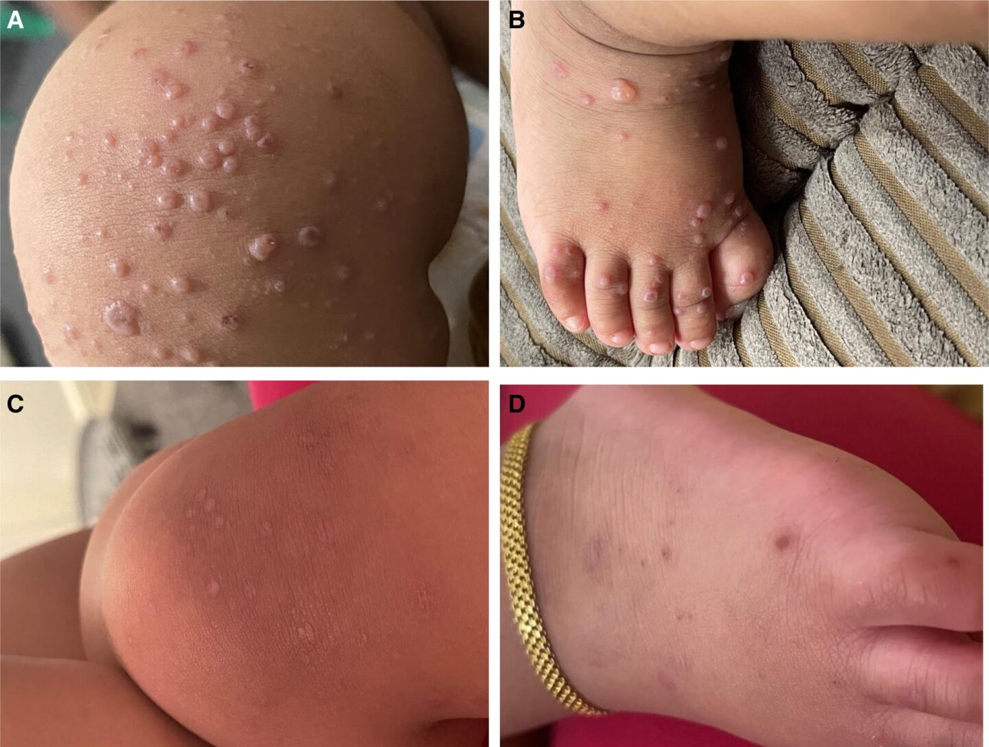 Four pictures of lesions on a child's body. They are numerous and very raised and red.