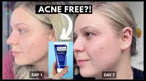 ⁦غسول رغوي للوجه Acne Foaming Wash Benzoyl Peroxide 10%⁩ - الصورة ⁦2⁩