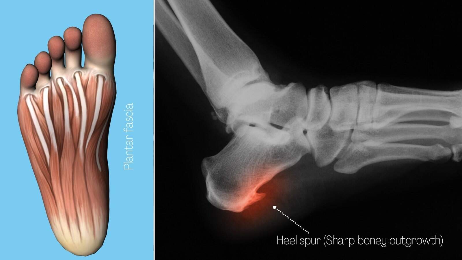 What Causes Sharp Heel Pains? 11 Easy Exercises to Fix it Permanently