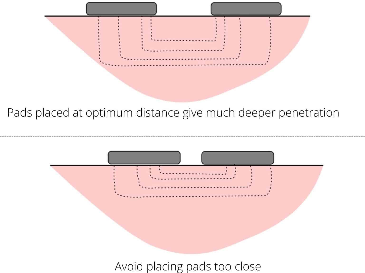 Short wave diathermy/SWD Uses, indications, contraindications
