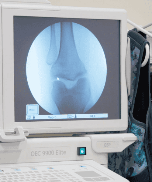 An Xray image of a knee cap showing the bone structure.