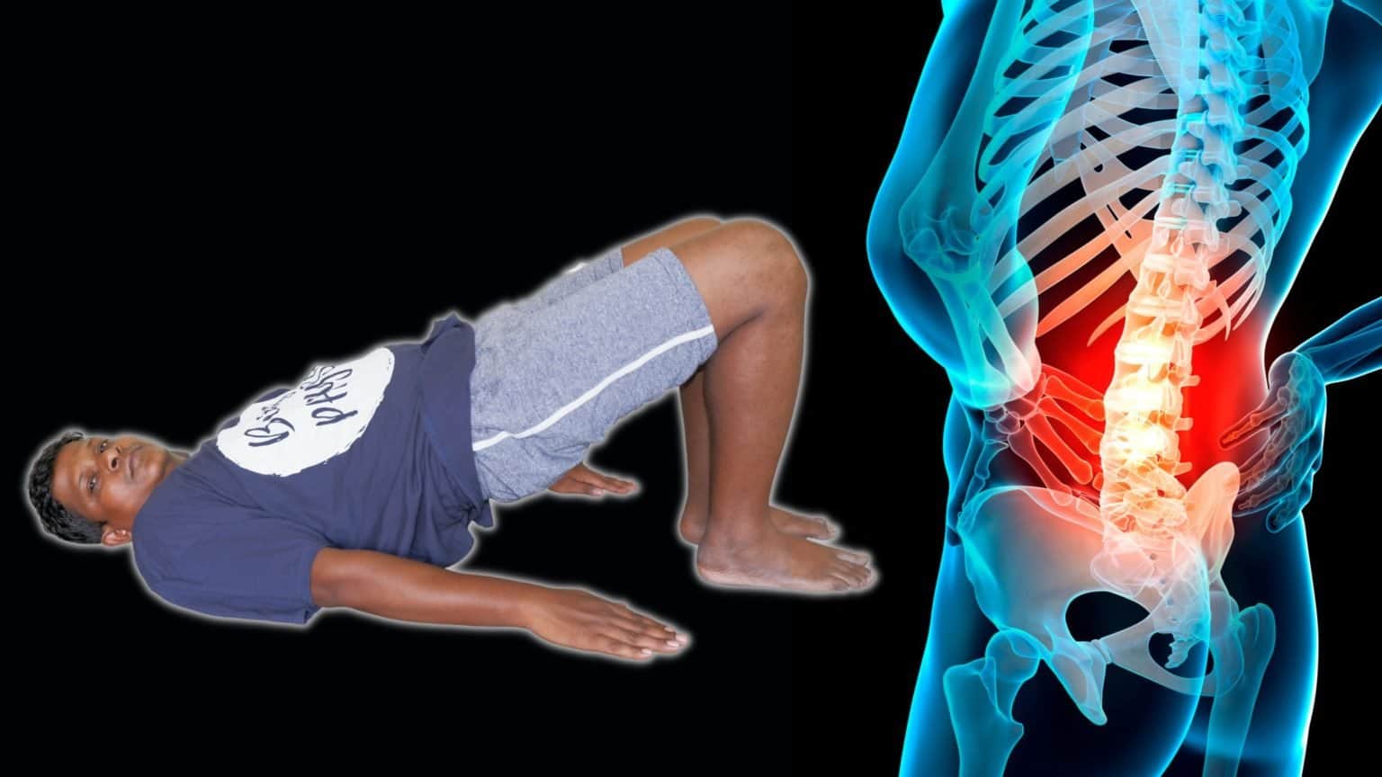 6 Easy Physical Therapy Exercises for Lumbar Spondylolisthesis Correction
