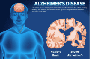 Alzheimer’s Disease | pRxEngage