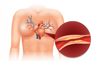 Dyslipidemia | pRxEngage