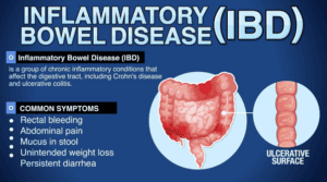 Inflammatory Bowel Disease | pRxEngage