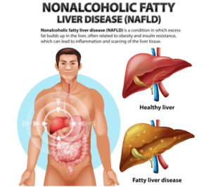Non-Alcoholic Fatty Liver Disease | pRxEngage