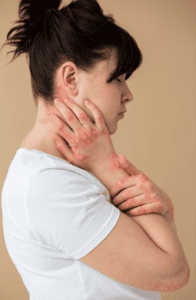 Systemic Lupus Erythematosus Disease | pRxEngage