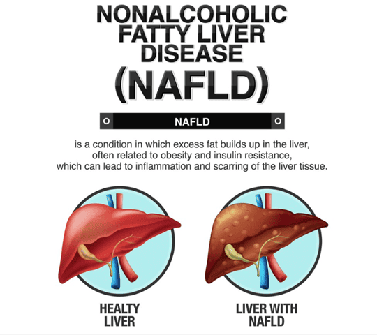 Understanding Non-Alcoholic Fatty Liver Disease