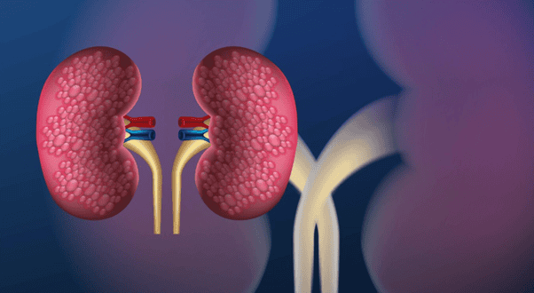 Understanding Proliferative Lupus Nephritis: A Patient Guide