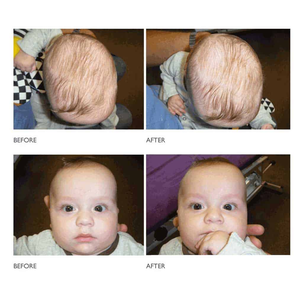 Torticollis in infants - before and after photos