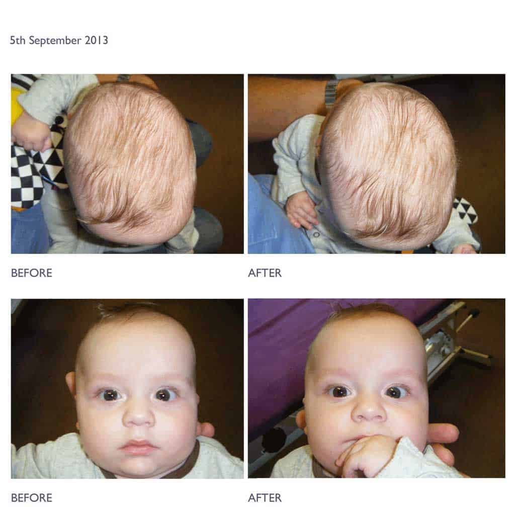 Before and after pictures - Torticollis treatment after one 10 minute session.