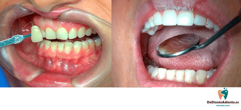 Carillas de composite o reconstrucciones con composite