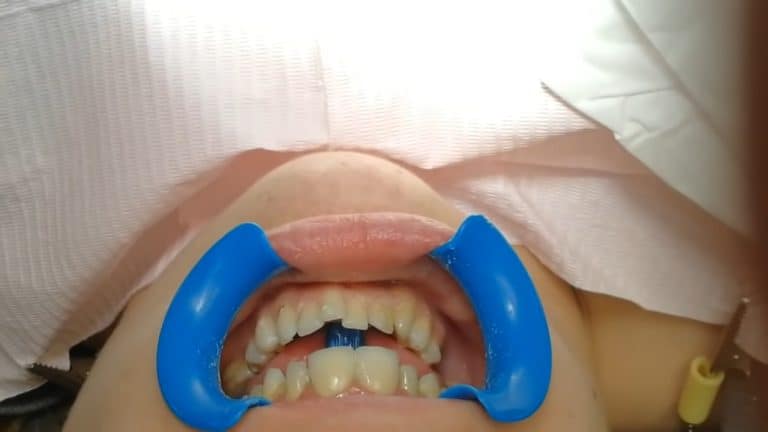 Carillas dentales: ¿Qué son y cómo funcionan?