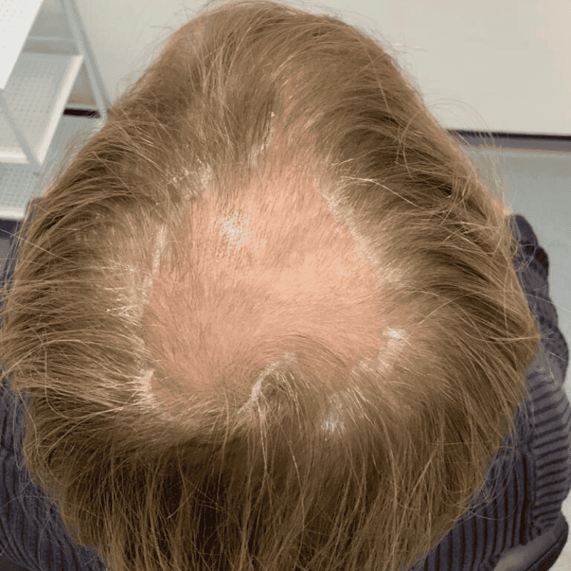 Types of Hair Loss Explained – The Science of Hair Loss