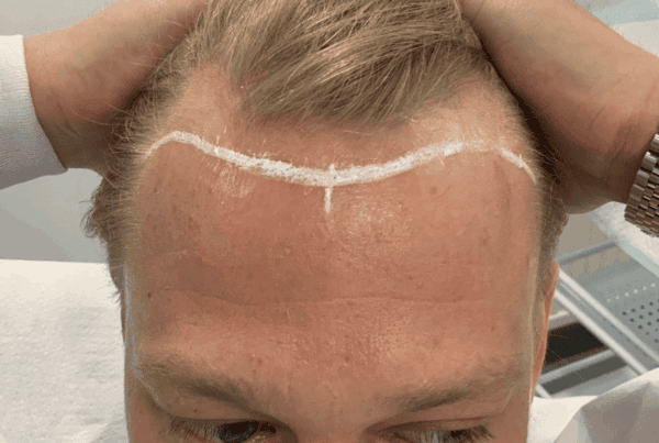 hair transplants vs hair systems?