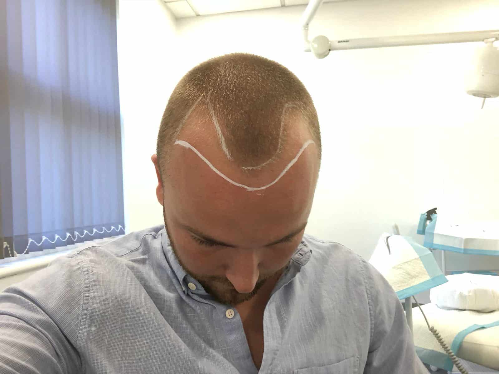 Hair Regrowth after a transplant