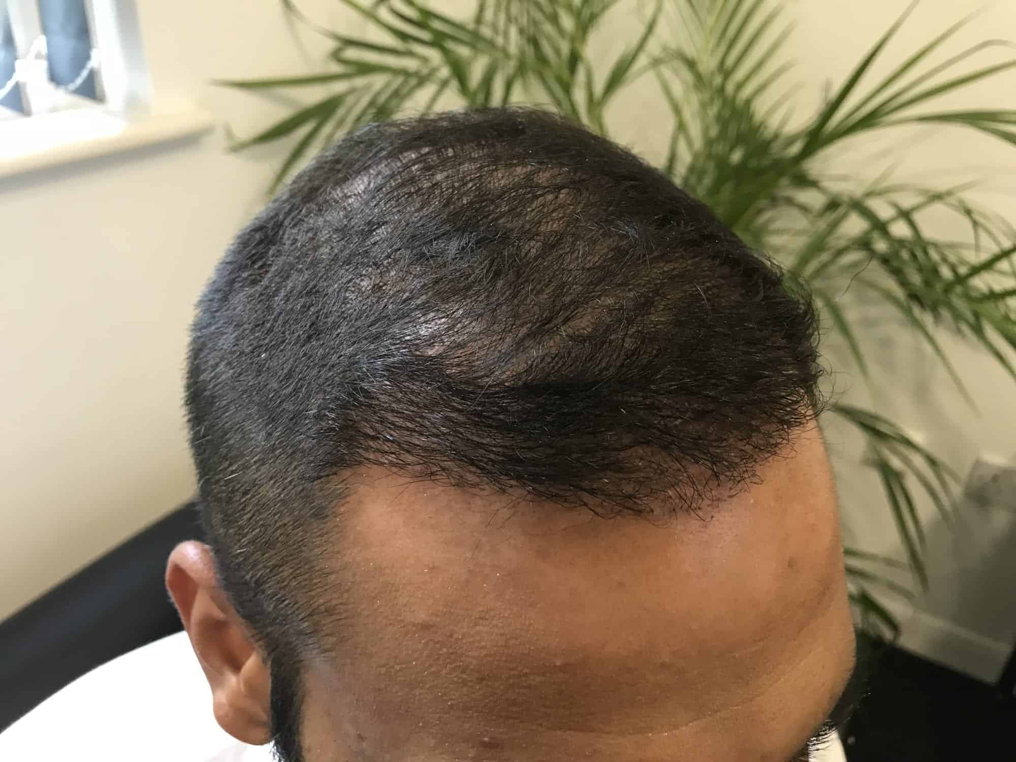 4 Months after