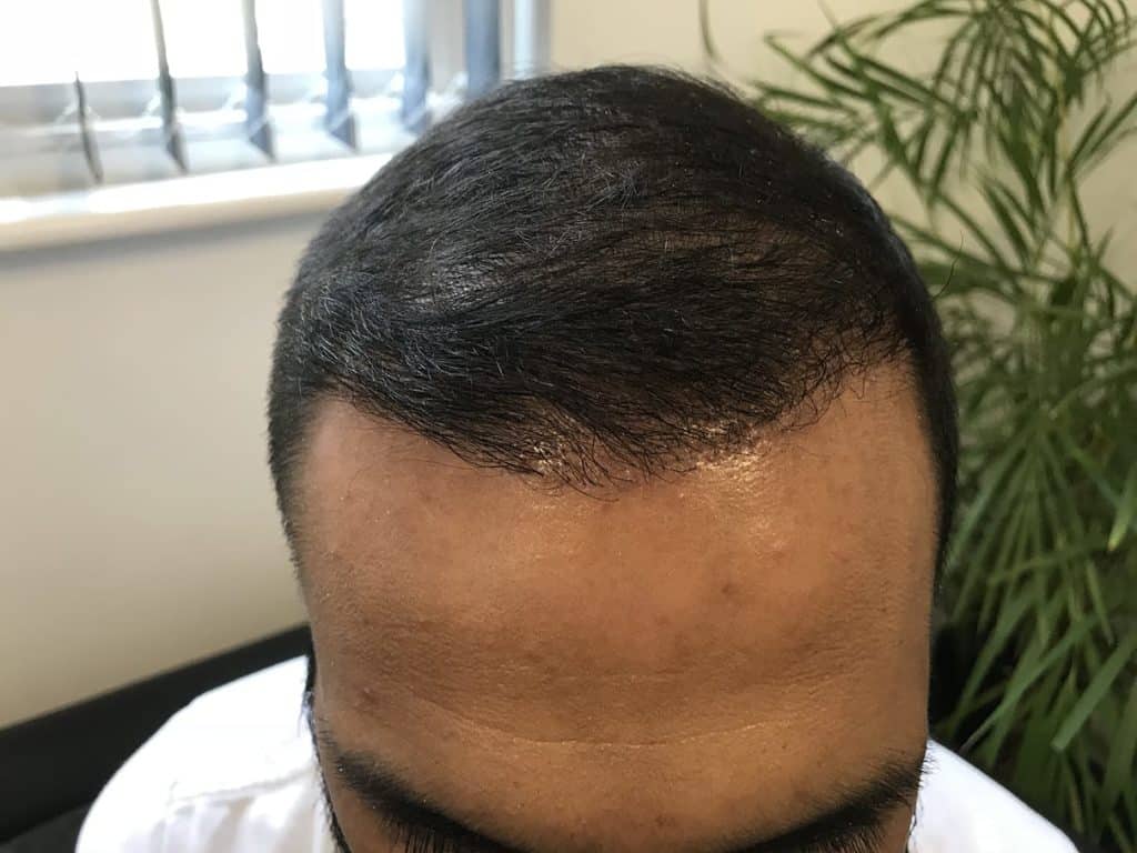 4 Months after2