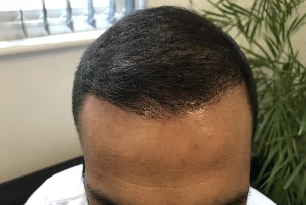 4 Months after2