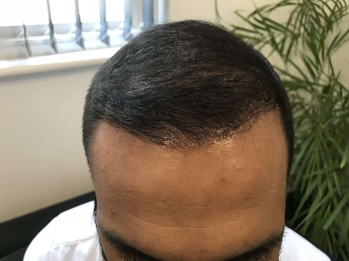 4 Months after2