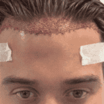 James Lock Post surgery