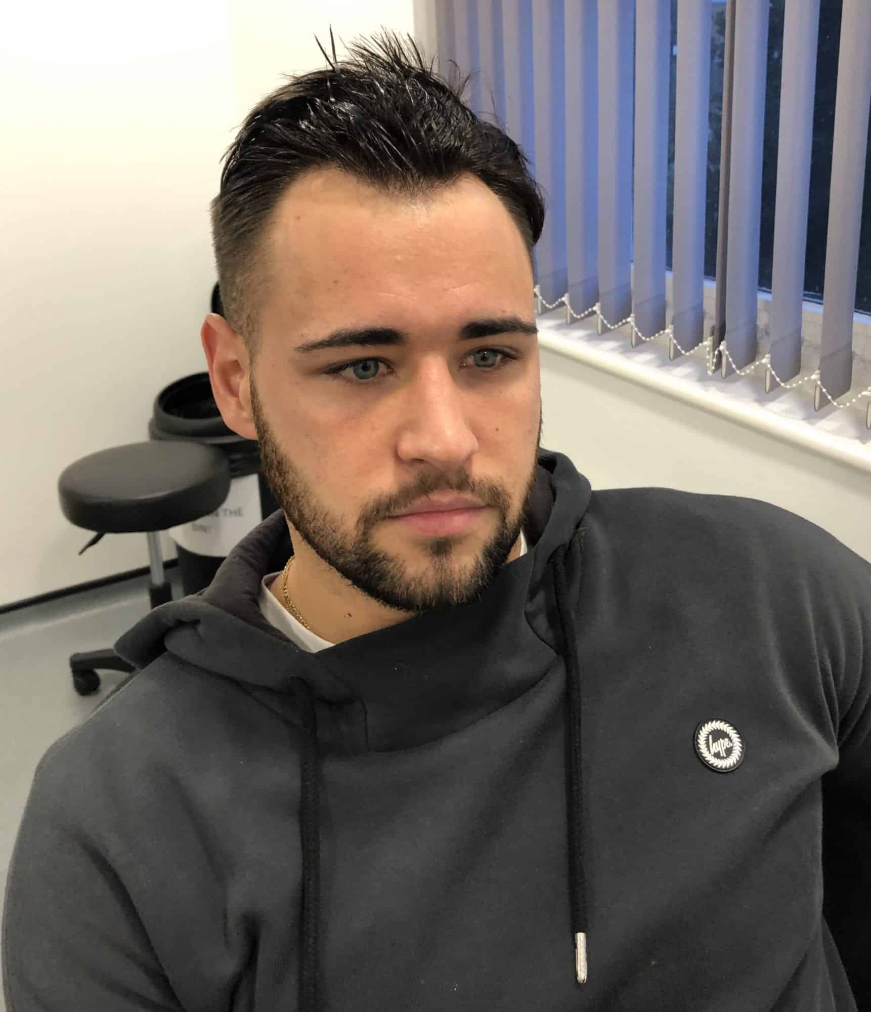 Kieran Nicholls from 2018 Love Island has Hair Transplant with KSL Clinic
