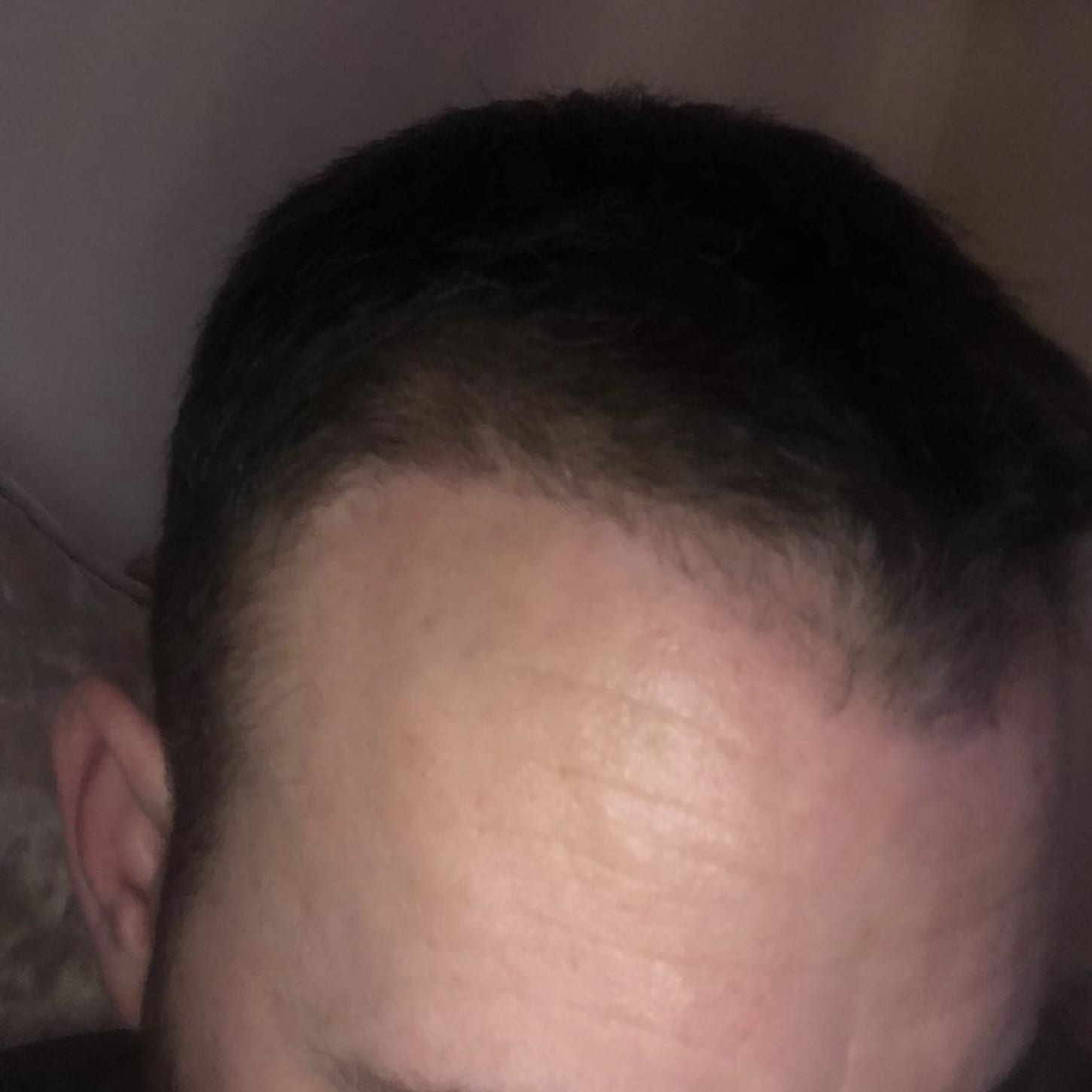 3 months after hair transplant