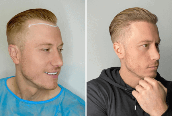 stages of hair transplant week by week
