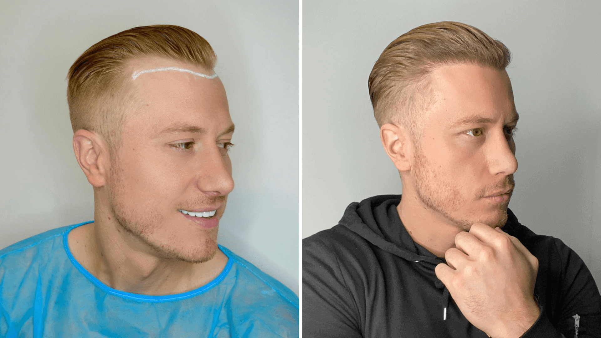 stages of hair transplant week by week