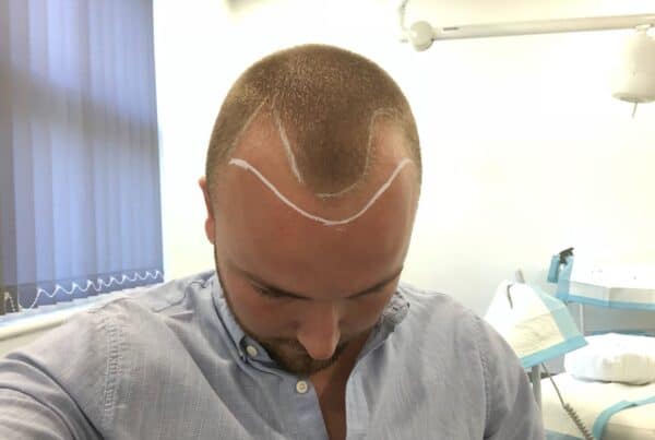 hair regrowth stages
