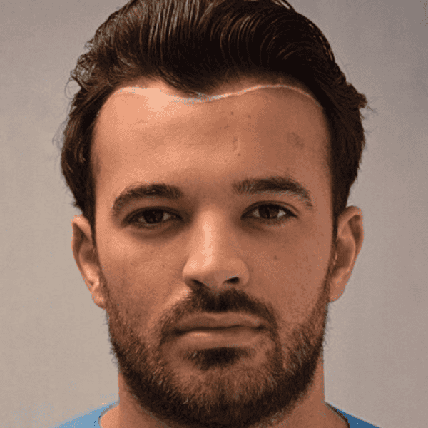 KSL hair transplant