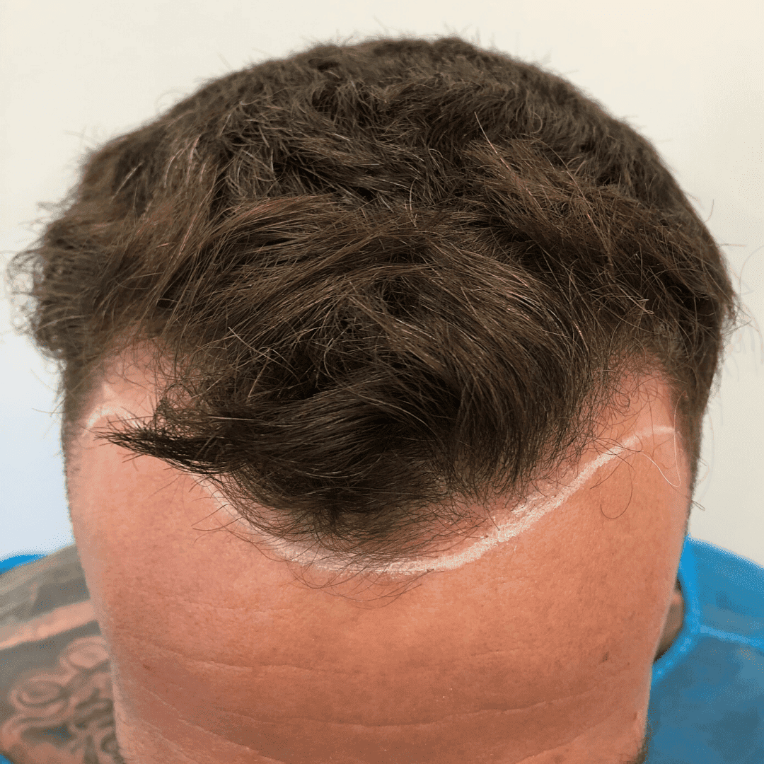 KSL hair transplant