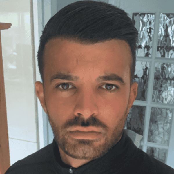 KSL hair transplant