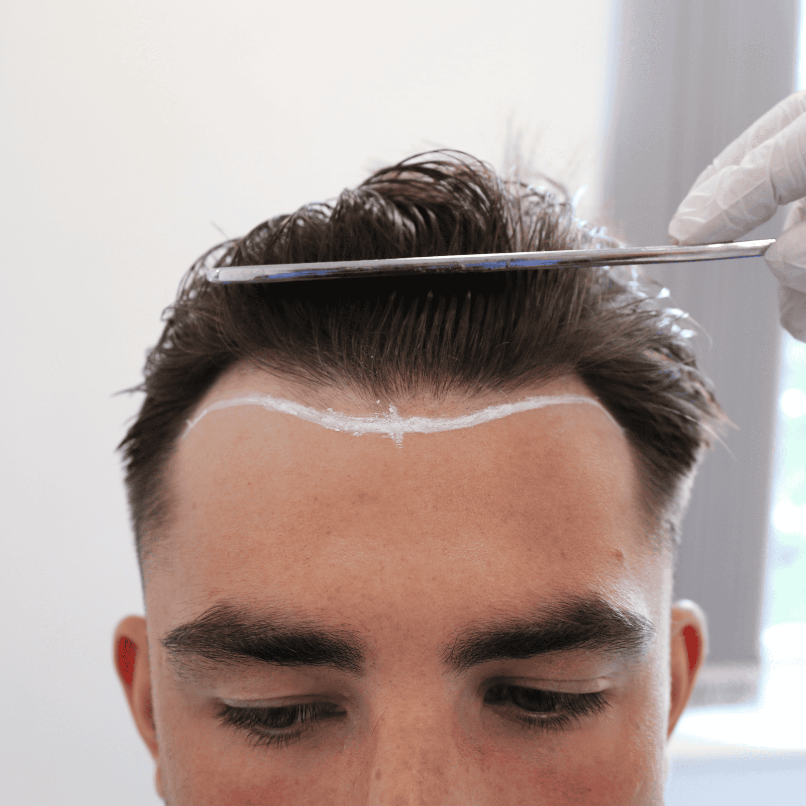 When Is It Too Late For a Hair Transplant?