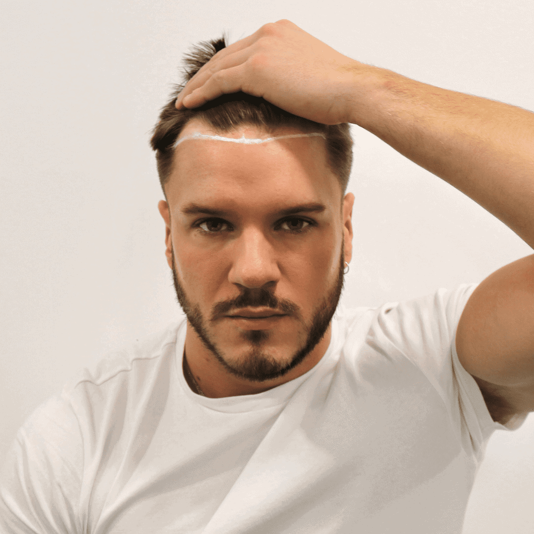 KSL hair transplant