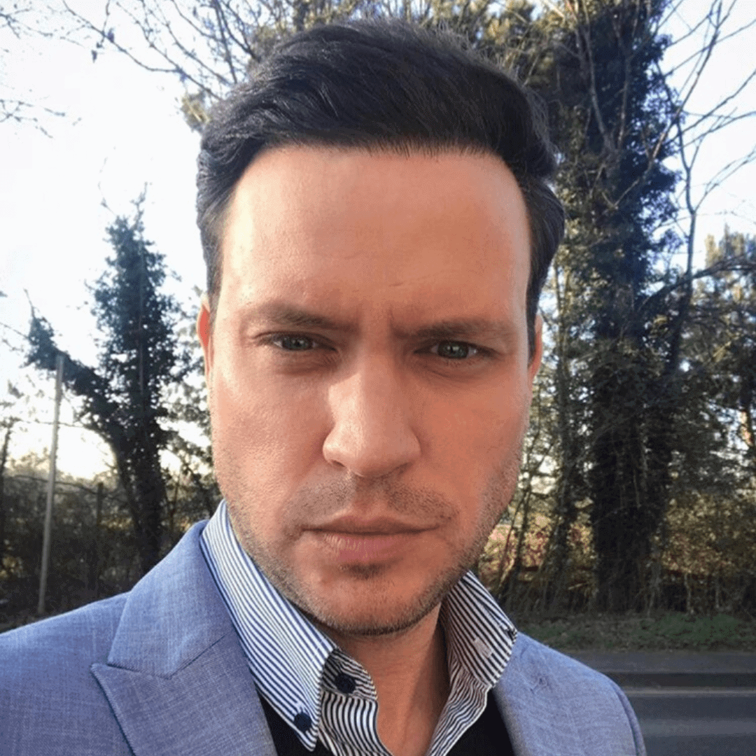 KSL hair transplant
