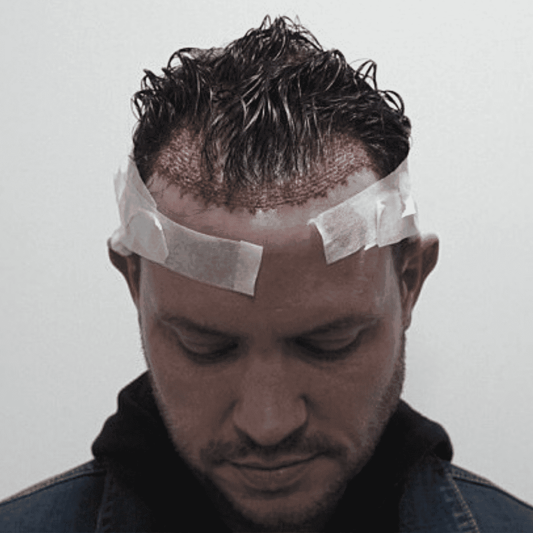 KSL hair transplant