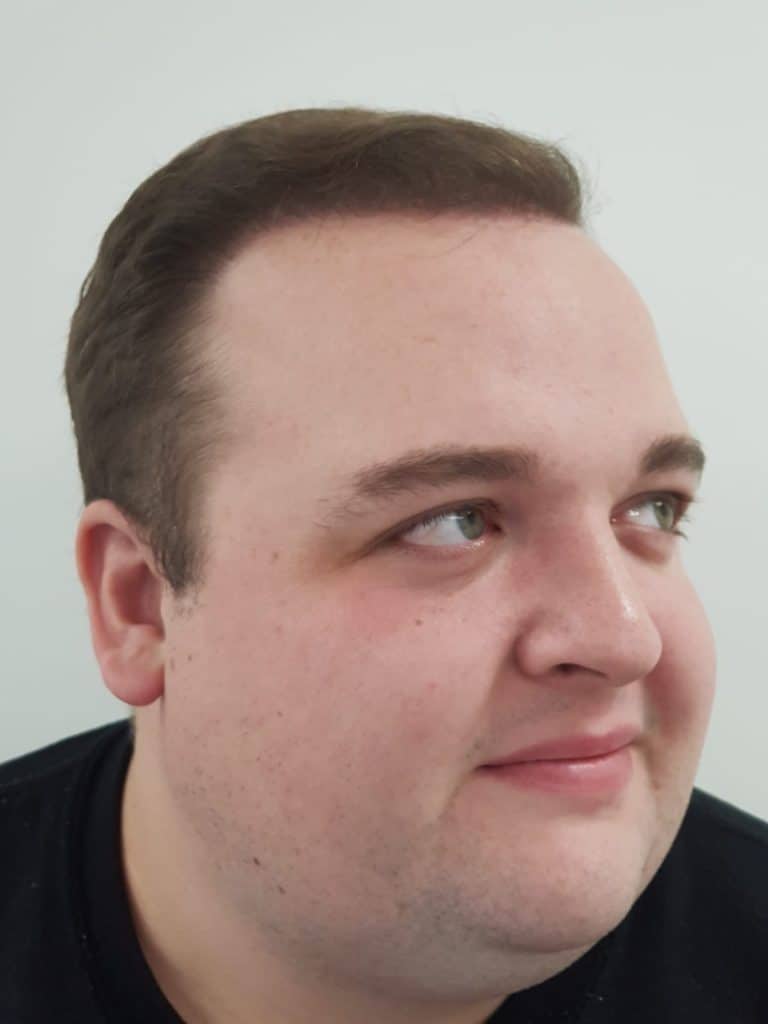 KSL hair transplant